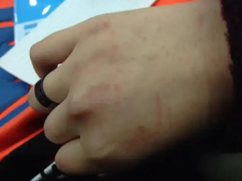 右手手背上有红点还有几道红痕 不痛不痒没什么感觉 这是什么原因呢