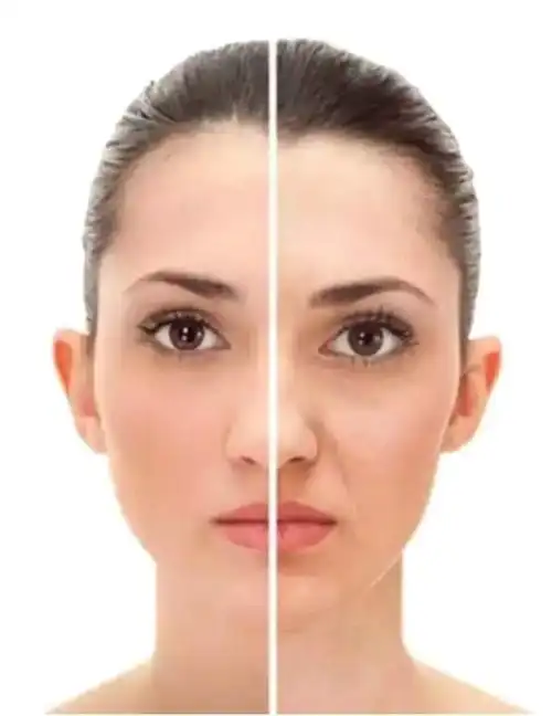 南京苏王——女性30岁之后,如何口周,眼周抗衰