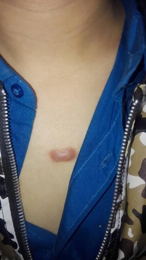 在我身上有两年的时间了.是不是粉瘤?