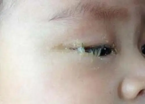 5岁宝宝眼睛突然看不见了,家人以为是上火,检查后医生:来晚了