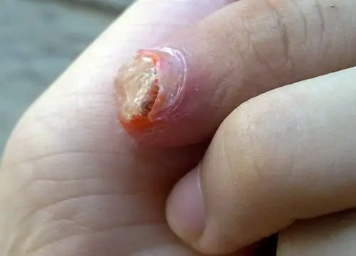 手指甲里面长了一个组织,求救!很急,有图.