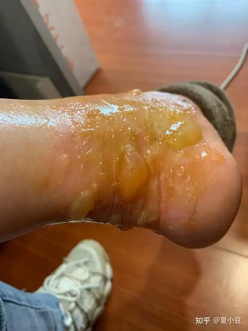 浅二度~深二度烫伤过程