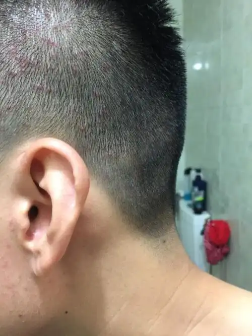 头皮上长了很多痘痘 不知道是不是上火还是疾病