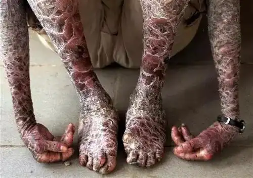 18岁职业渔翁浑身长满鱼鳞变鱼人兄姐皆得怪病早夭