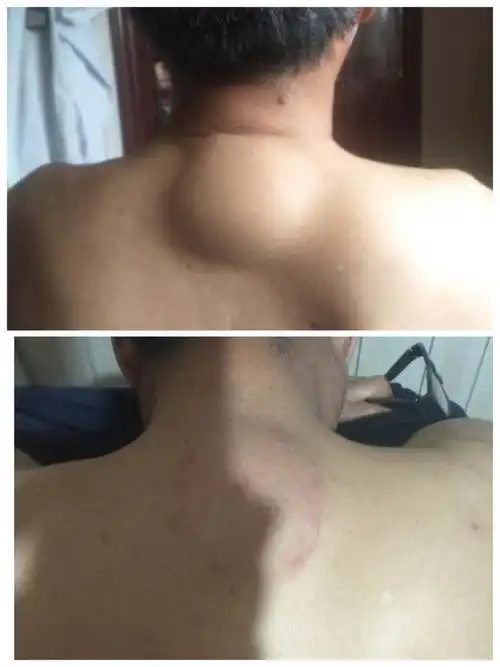 辛大夫治疗的富贵包患者对比图