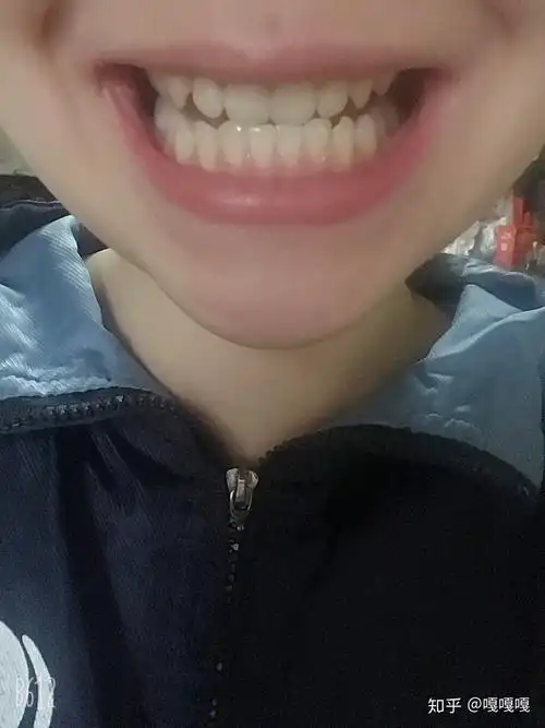 为什么我除了门牙其他牙都很尖?