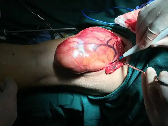 老汉自以为的腿部肌肉原是大肿瘤 - 好大夫在线