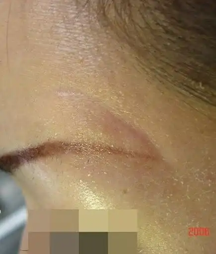 这是右颞部刀伤后留下的凹陷疤痕.