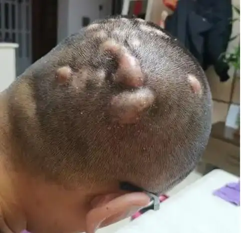 王利兰:毛囊炎和梅毒的区别图,看图秒懂!