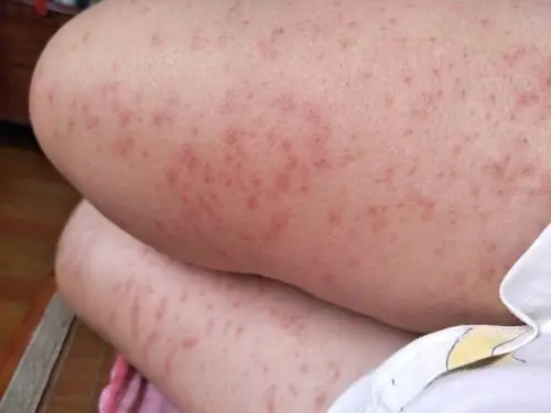 全身过敏长湿疹