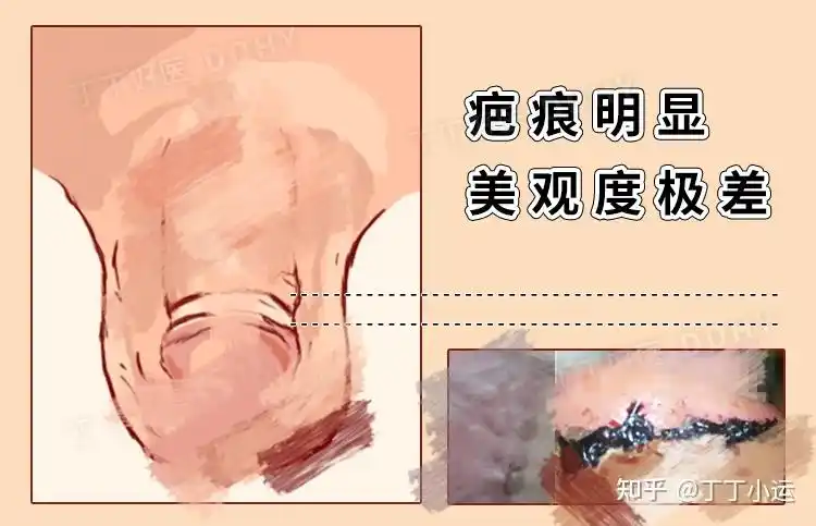 抖音小伙网购器械自己割包皮丁丁从5方面论证行不行