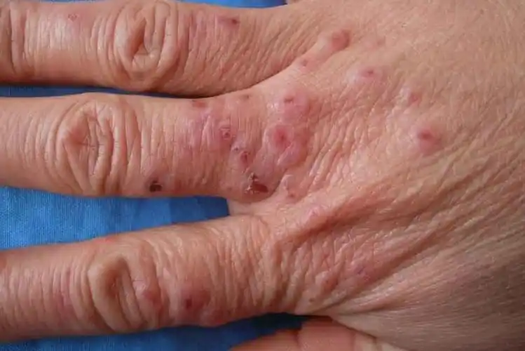 寒冷性湿疹表现为身体局部接触寒冷刺激后皮肤干燥,脱屑,伴有局部红斑