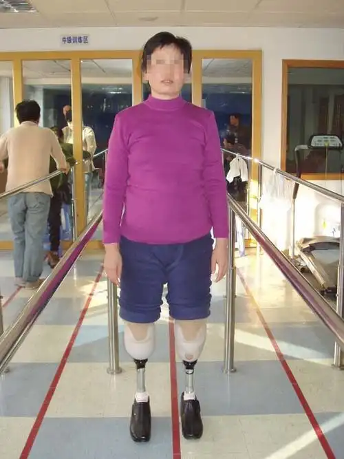 小腿假肢的介绍