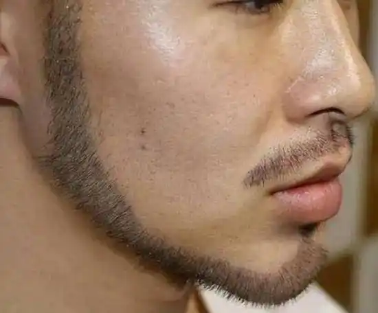 早上刚刮了胡子,隔早就长出来了,胡子长太快,意味着什么?
