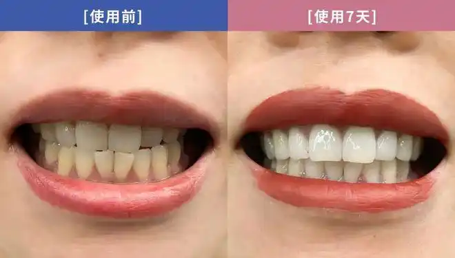 黄牙党注意牙齿变白的靠谱法子这就告诉你