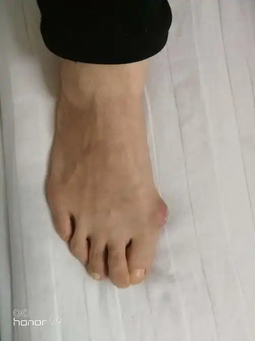 我院骨科开始采用手术截骨矫形治疗拇外翻畸形,疗效确切,患者满意度