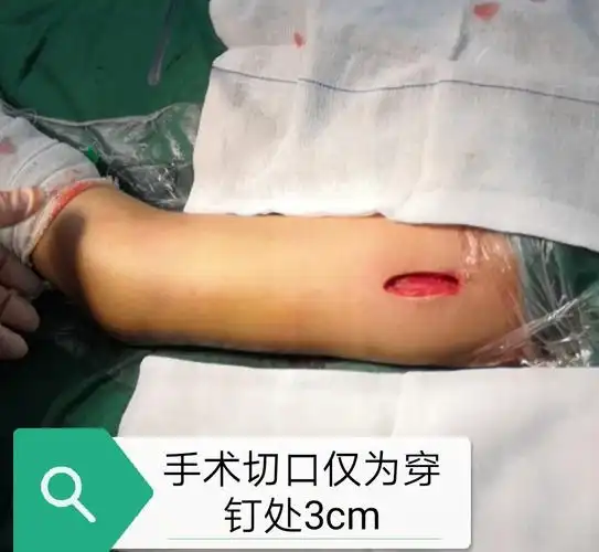 固镇博爱医院 骨科 分享二例儿童骨折闭合复位钛制弹性髓内钉(ten)内