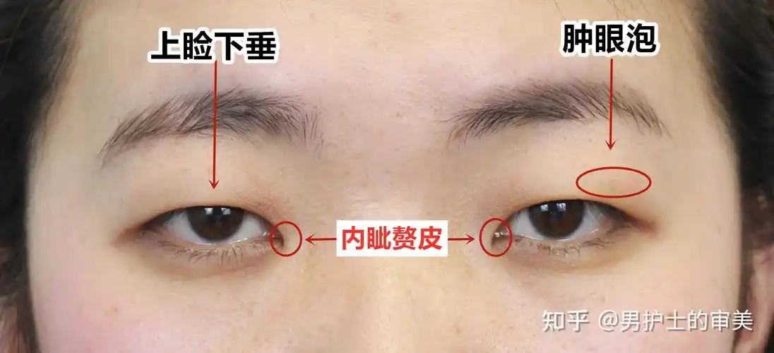 眼睑下垂是做双眼皮手术还是什么手术? - 知乎