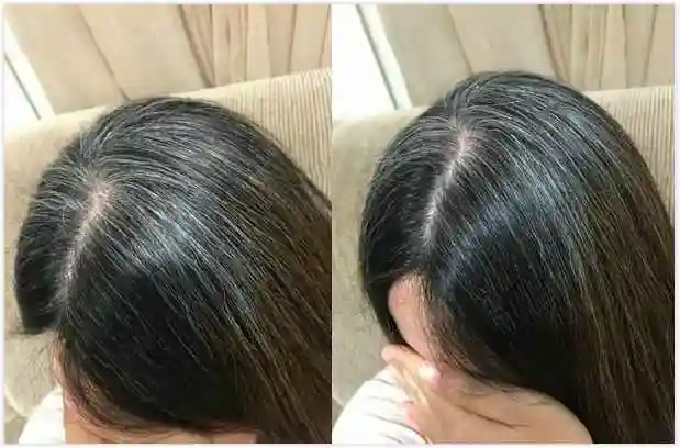 连吃三周白头发不见了, 40岁头发白是什么原因引起的