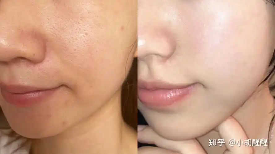 毛孔粗大真的不可逆吗?如何才能正确的收缩毛孔? - 知乎
