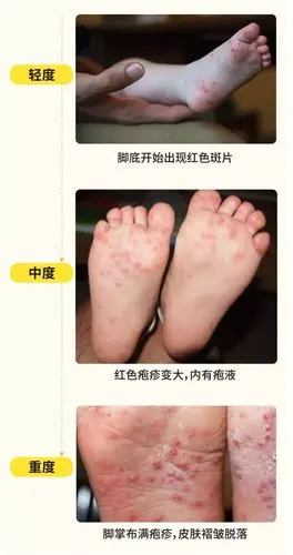 手足口病进入高发期家长们快为宝宝们做好防护吧