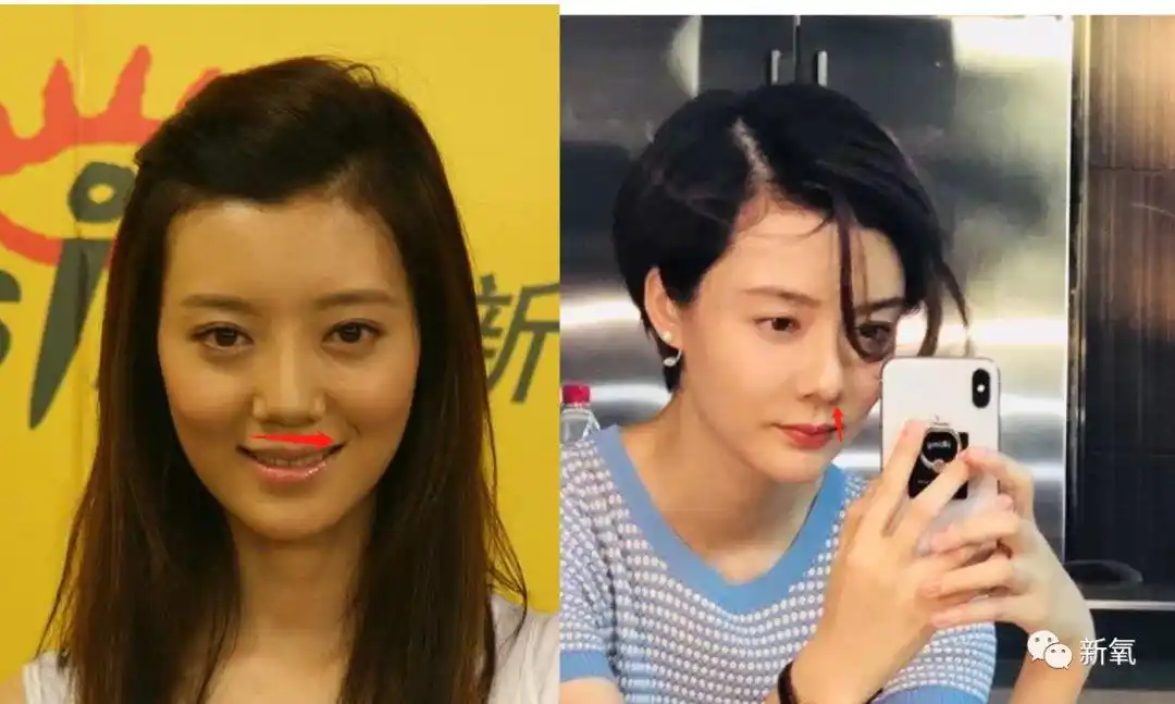 假体|鼻头|车晓_新浪新闻