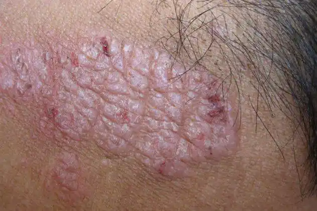 皮肤病看图识病