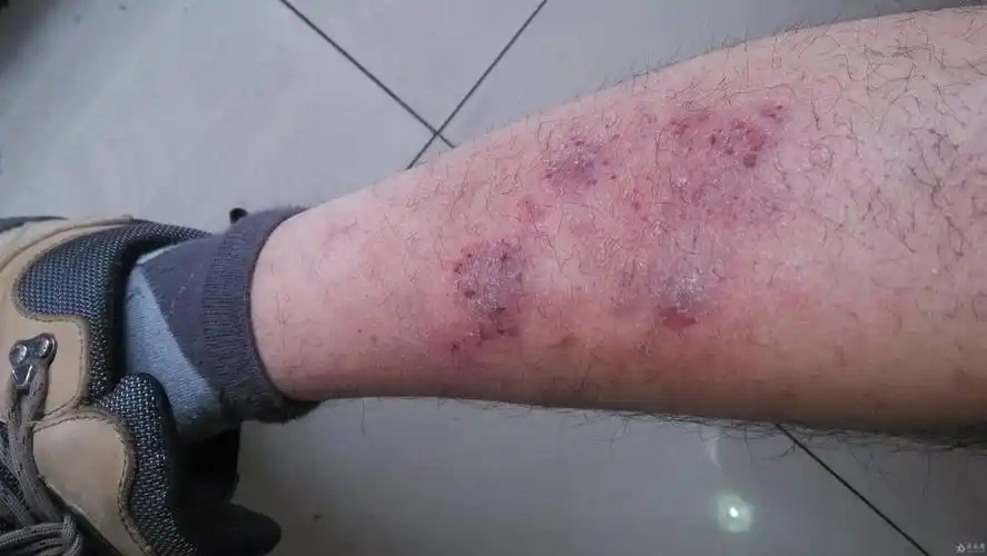 病案讨论顽固皮肤湿疹求助