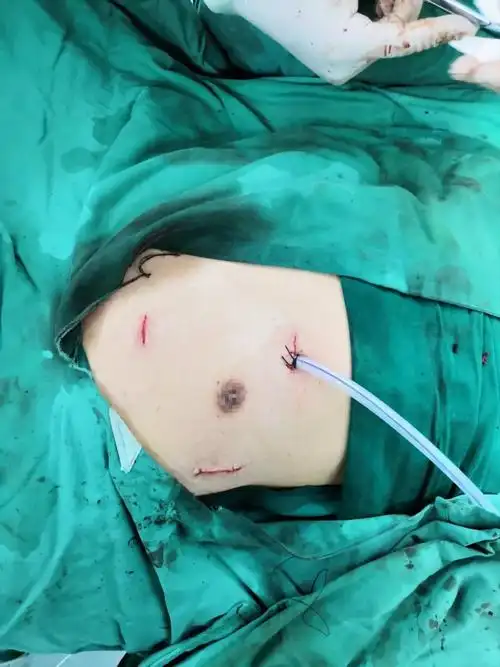 淄博市中心医院成功完成我市首例全胸腔镜下心脏外科手术