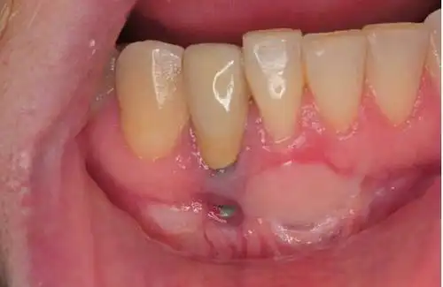 患有牙周炎不能做种植牙