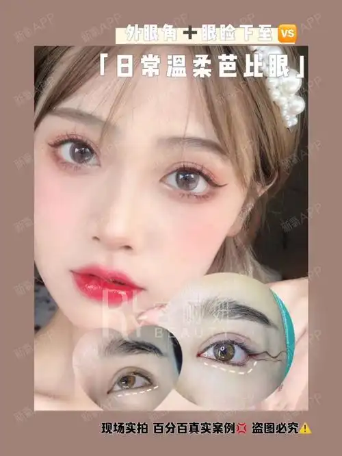 眼睑下至外眼角术后即刻对比