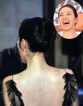 秦岚可真skr个狠人脸上一百多颗痘痘居然一一挑破