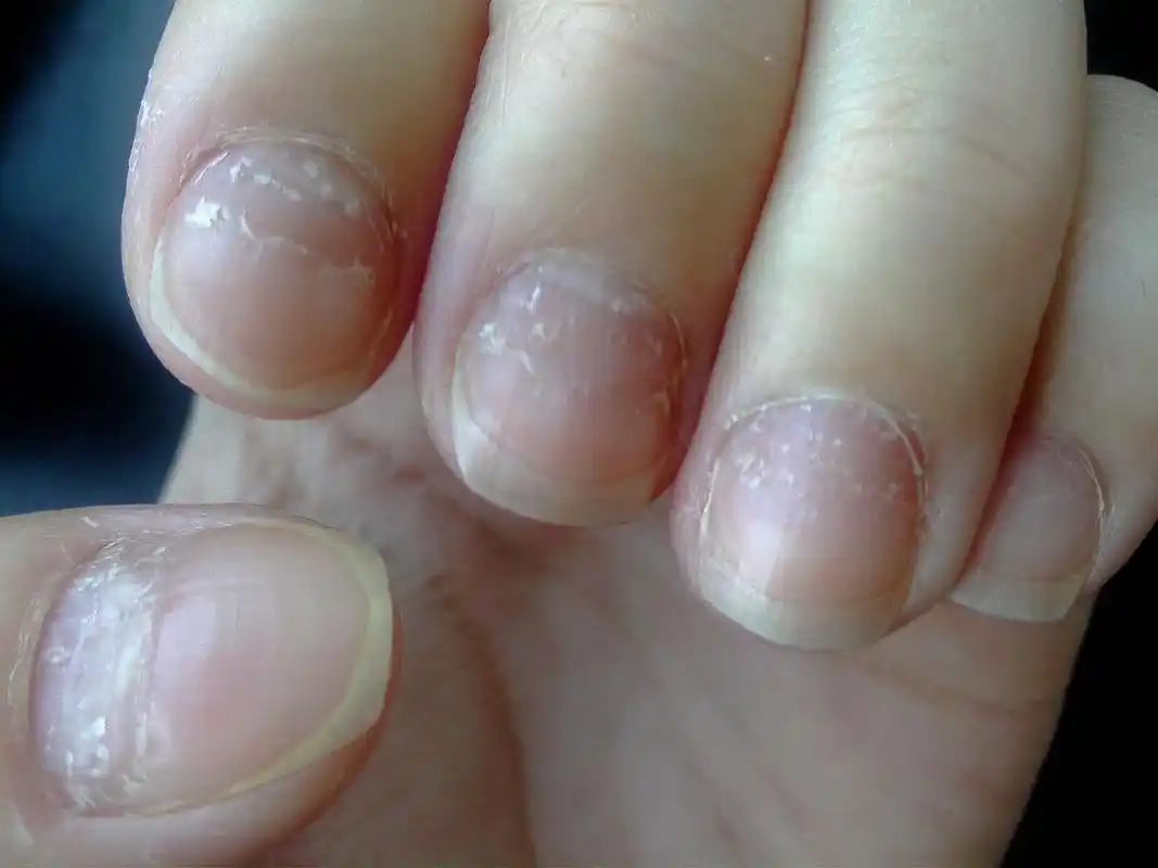 【心脏不好的人,指甲会有4个表现,若没有,恭喜你心脏功能还不错】!