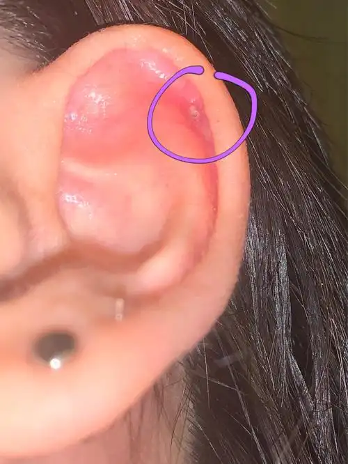 耳骨发炎6315(治疗教程来啦)