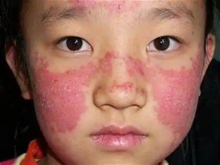 红斑狼疮是一种极其复杂的皮肤疾病,患病后可对人体多个脏器进行损害