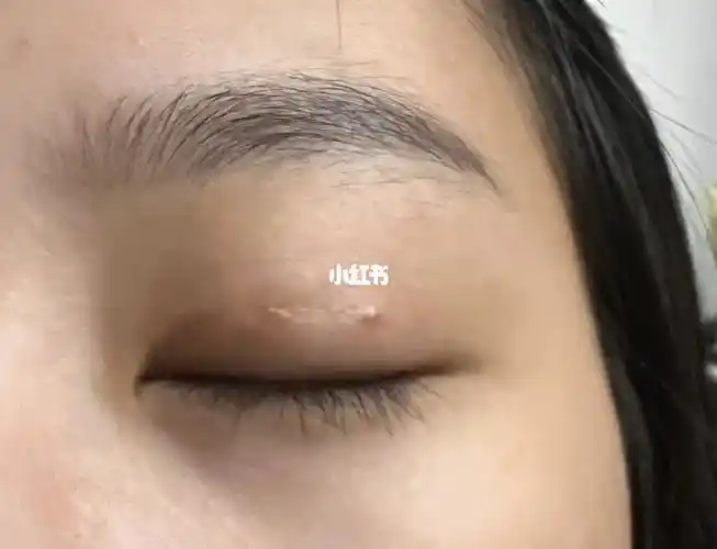 day16增生眼尾有个小疙瘩