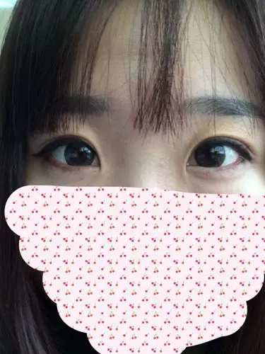 现在觉得眼角太包了,想开一下眼角.亲们看看我的眼角