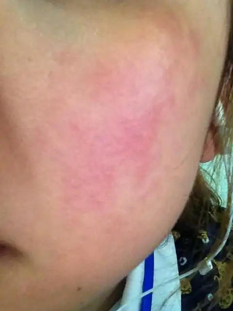 我感觉我的皮肤吸收能力很差.最近晒了太阳而且还过敏.