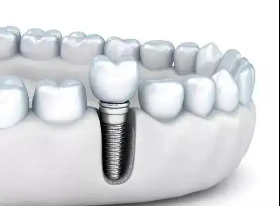 看种植牙博览会直播,种植体免费抽!