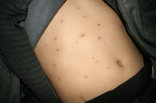 病毒性皮肤病春季皮肤病病例征集