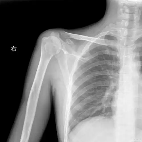 【讨论】右肩胛骨病变(20060207)