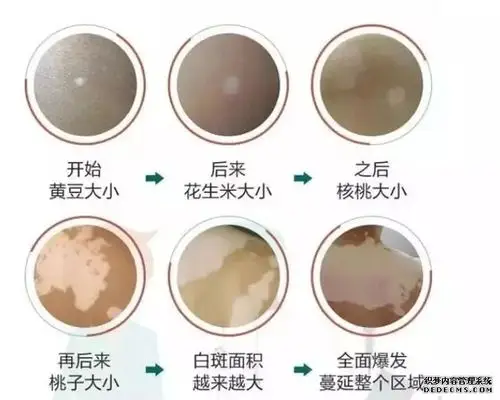 这样诊疗,可能让你的白斑加速扩散