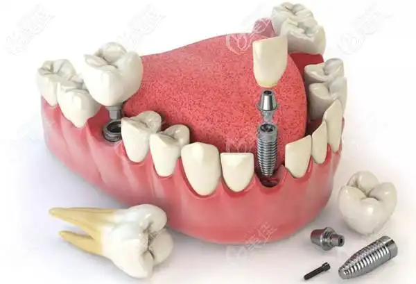 种植体基台牙冠展示图