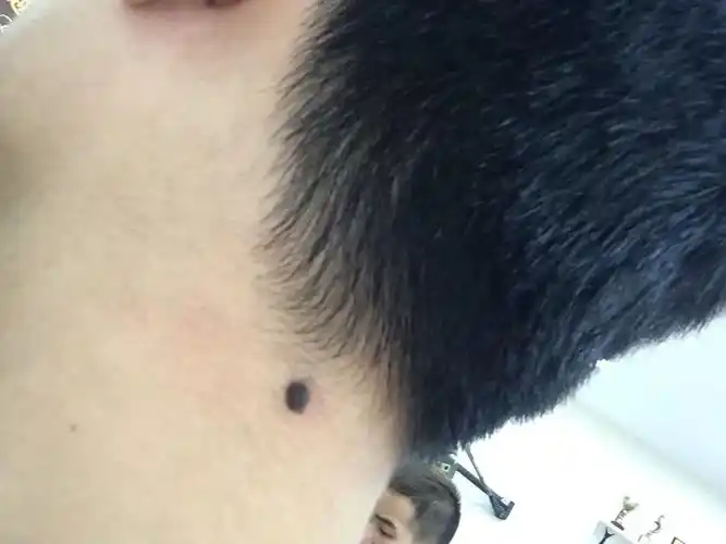 后颈有颗痣变大变硬了,按下去有点疼,要不要紧,看到网上说的很恐怖