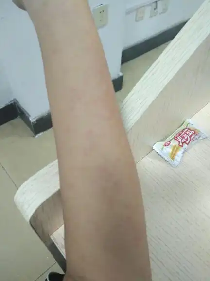 手臂很痒 略红 有疙瘩 至少去医院医生说是日光性皮炎 开了点抹的吃的