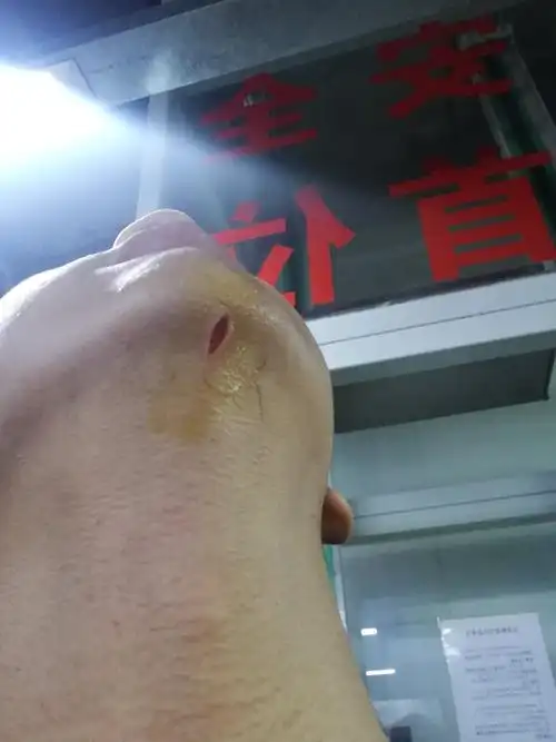 这样的伤口可以自己更换纱布或创可贴吗?