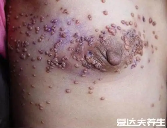 不同时期的艾滋病皮疹图片及症状,不痛不痒的小红点更需注意