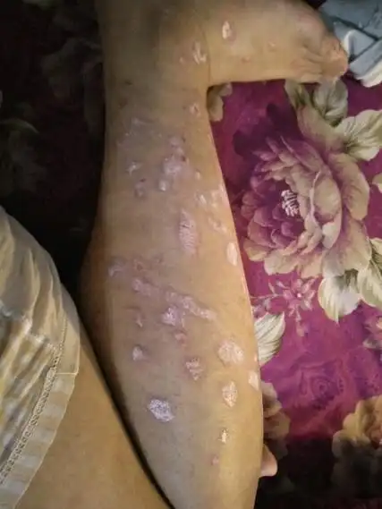 什么是癣图片初期