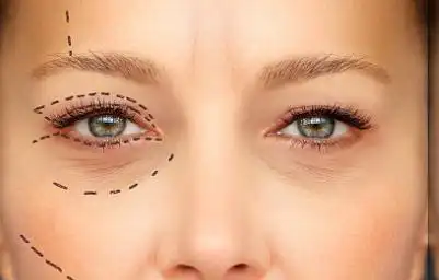 上眼皮抽脂的效果还是非常不错的,尤其是对肿眼泡的人们效果格外明显