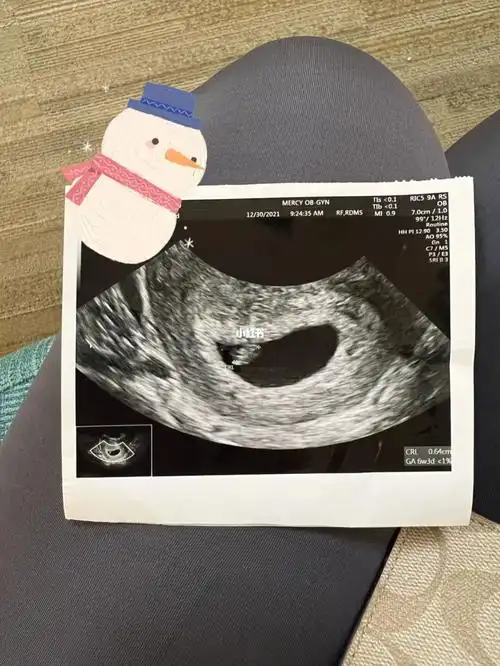 胎心胎芽新鲜出炉